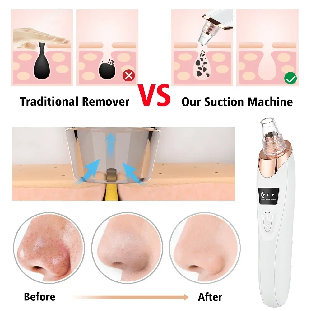 PoreRemover: Genopladelig Smart Hudorme, Hvide Hudorme Porer Fjerner Kit