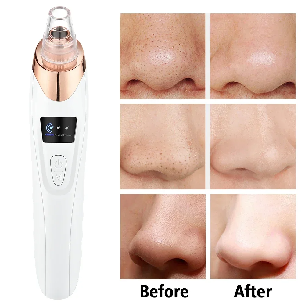 PoreRemover: Genopladelig Smart Hudorme, Hvide Hudorme Porer Fjerner Kit
